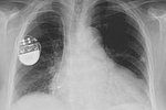 La FDA alerte sur les risques de piratage de certains pacemakers